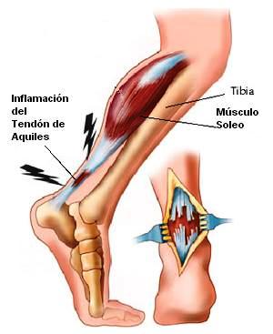 tendon de aquiles